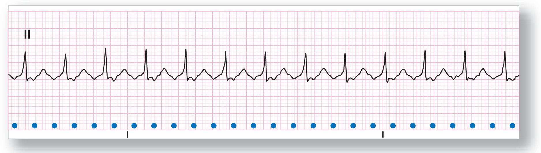 A rhythm strip from lead 2 shows sharp peaks of the QRS complex, a broad peak of the T wave, and a depressed ST interval.