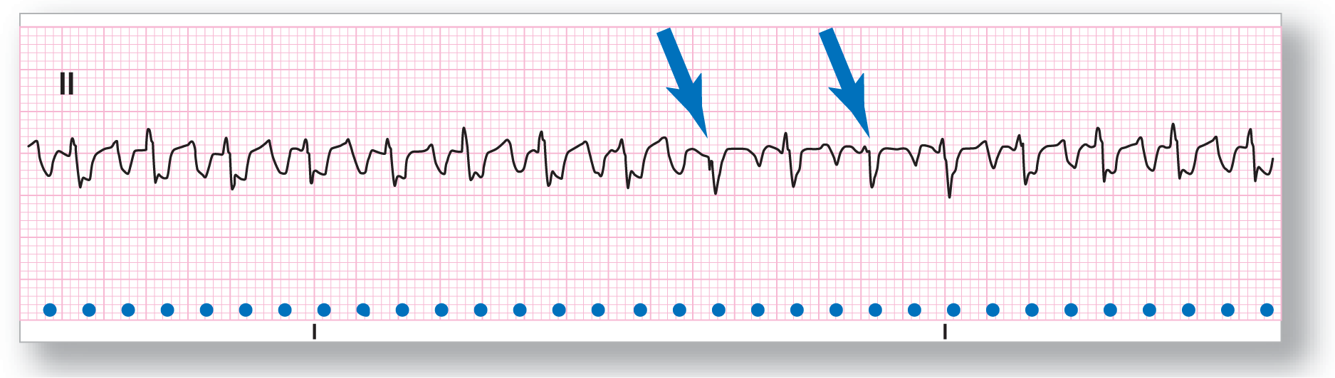 A rhythm strip from lead 2 shows two square waves, one flat and the other with a peak. At two locations, a sharp dip is located and marked by arrows.