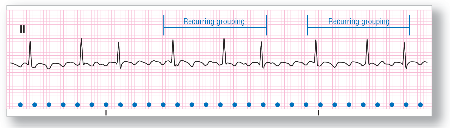 A rhythm strip from lead 2 shows that a recurring group consists of three sharp peaks occurring after three curved waveforms. The width of the curved waves in a group differs slightly.