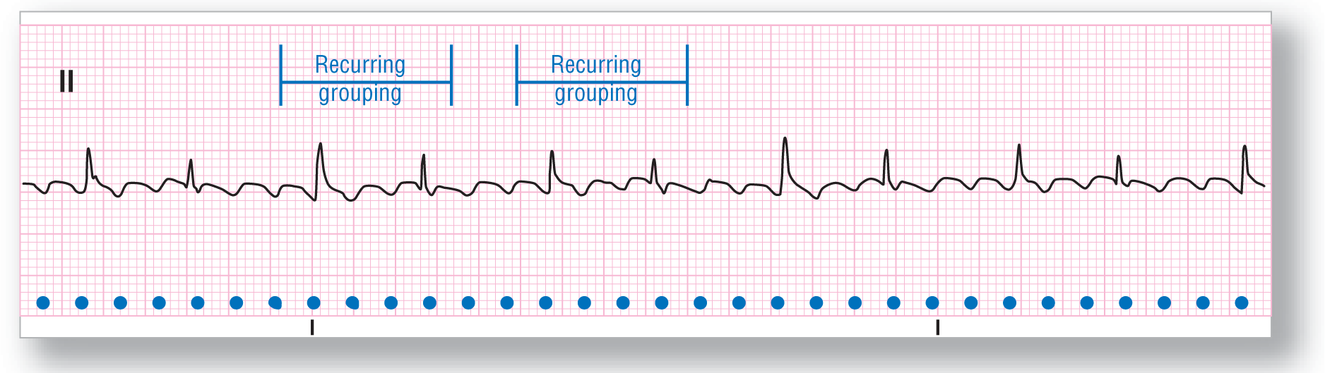 A rhythm strip from lead 2 shows that a recurring group consists of a curved wave, a tall and sharp peak leaning left, two curved waves, a tall and sharp peak leaning left, and another curved peak.