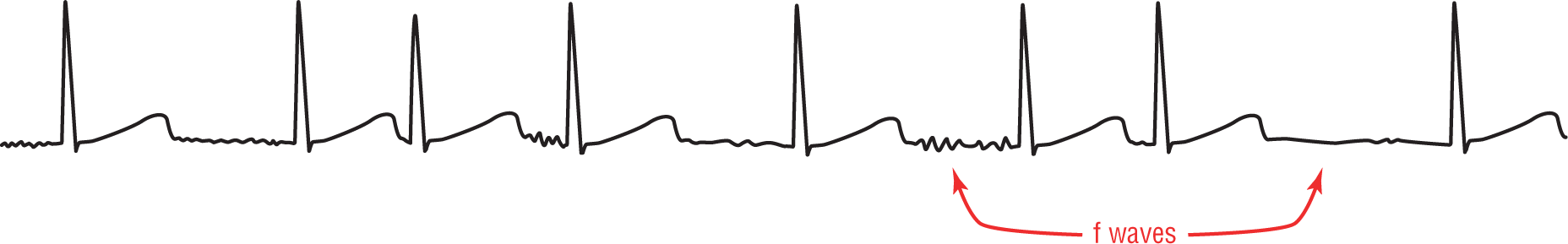 A rhythm strip shows sharp peaks of the QRS complexes occurring at irregular intervals. In place of P waves, there are mild fluctuations and flat regions, corresponding to f waves.