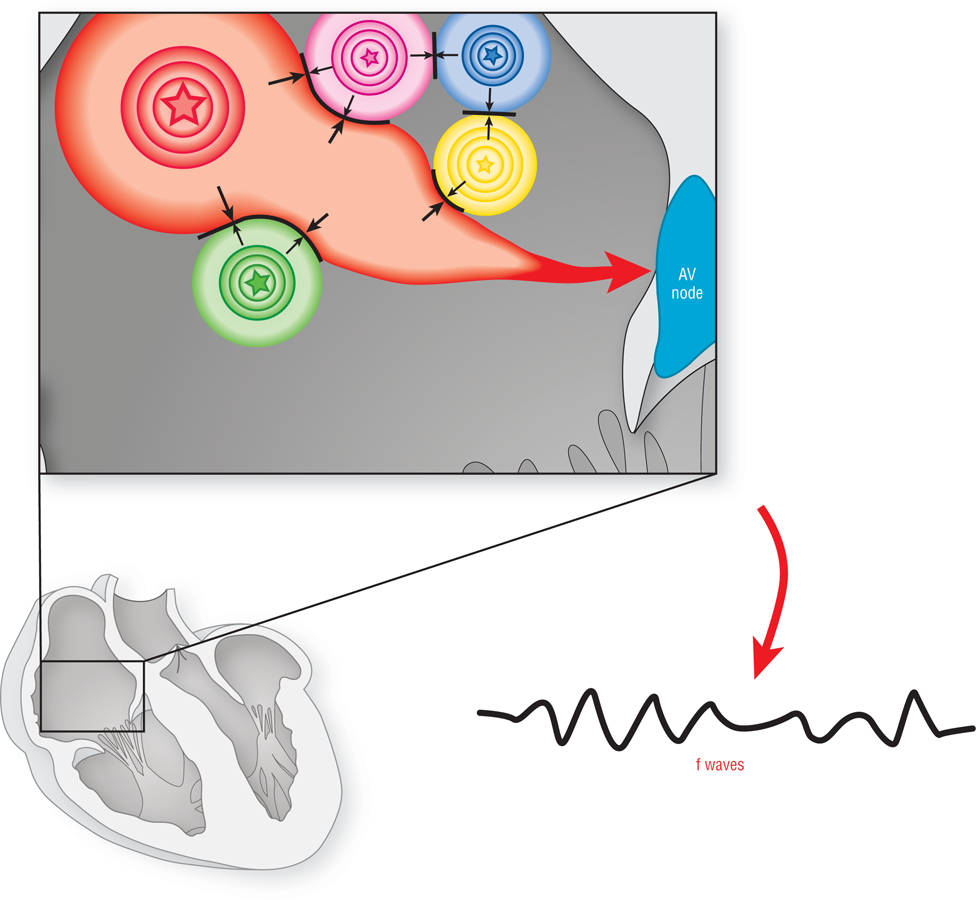 An illustration shows that in the atrium, pulses from an ectopic focus are modified by pulses from other foci before reaching the AV node. The resulting f waves have irregularly shaped peaks.