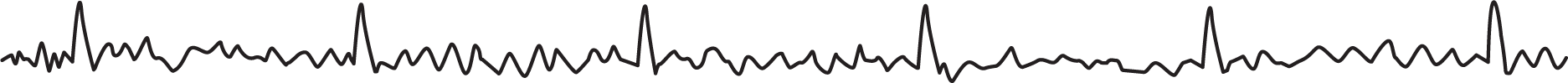 A rhythm strip shows small and sharp peaks of the QRS complexes occurring at irregular intervals between regions of strong fluctuations.