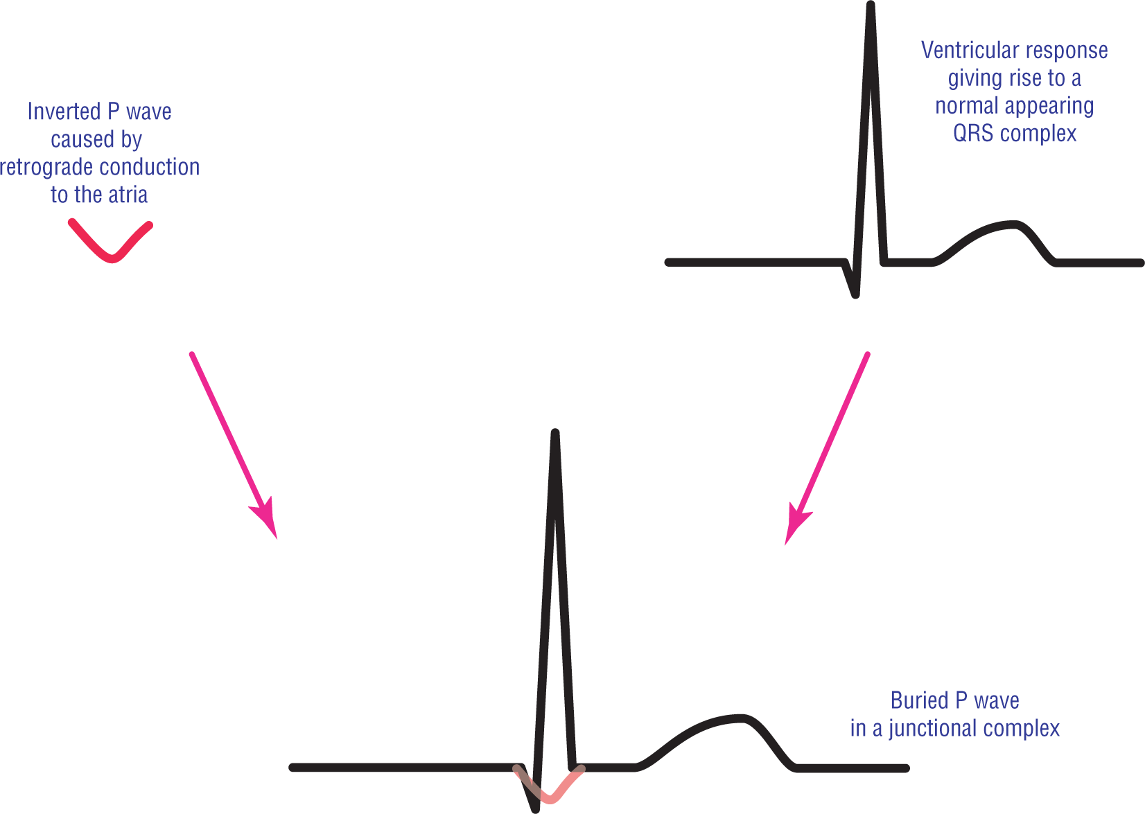 An illustration shows the ECG waveform of a junctional complex with a buried P wave.