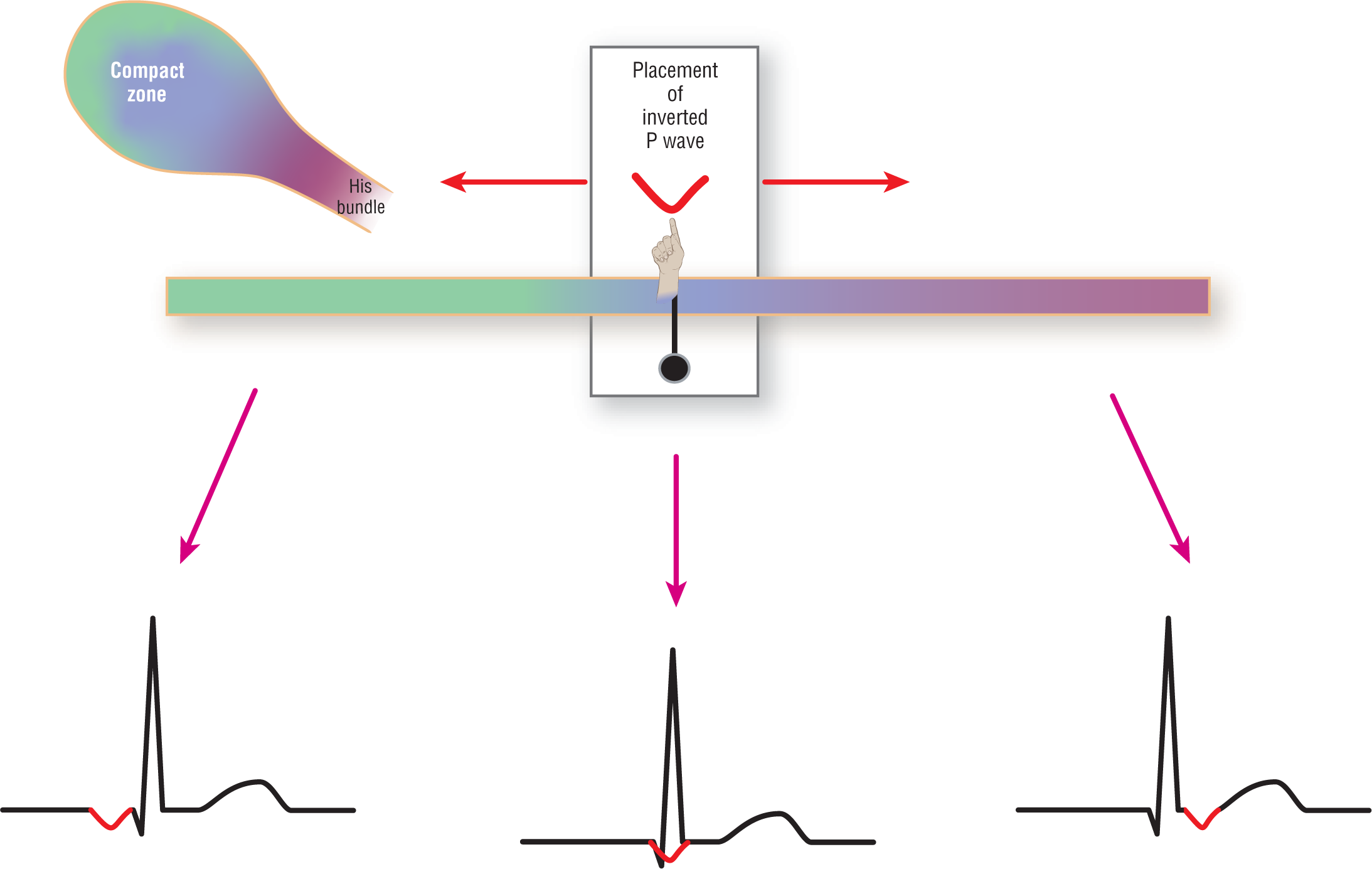 An illustration of a continuum shows the placement of inverted P waves when the complexes have different origins.