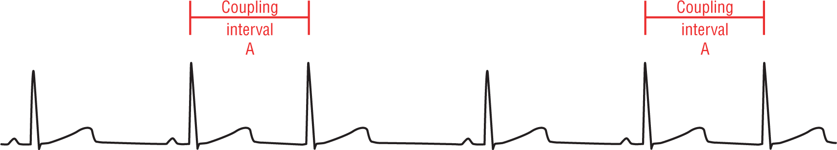 An ECG complex shows waveforms with normal patterns. The distance between a premature complex and its preceding waveform is labeled coupling interval. Two coupling intervals with same periods are labeled coupling interval A.