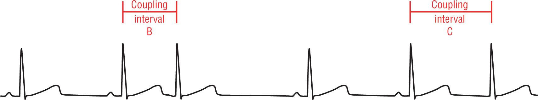 An ECG complex shows waveforms with normal patterns. There are two coupling intervals with different periods, labeled coupling interval B and coupling interval C.