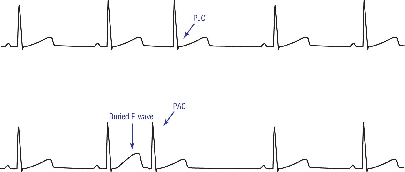 Two ECG complexes show the difference between PJC and PAC.