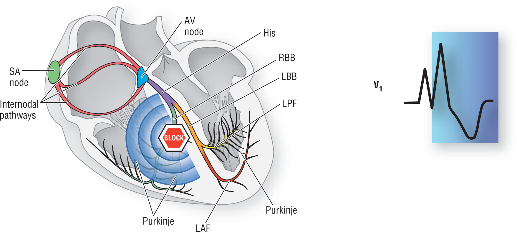 An illustration shows the structure of the impulse when an aberrancy occurs.