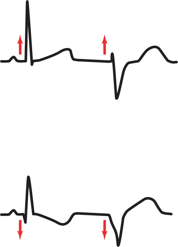 Two ECG complexes illustrate the method of identifying aberrancy in a complex.