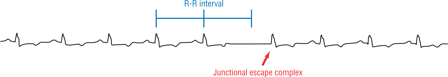 A rhythm strip illustrates junctional escape complex.