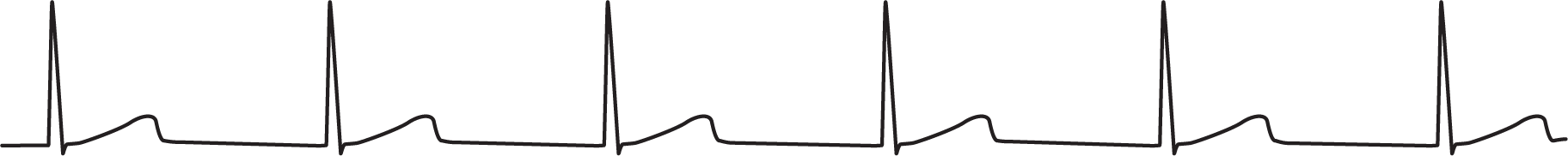 A rhythm strip shows sinus rhythm with missing P waves.