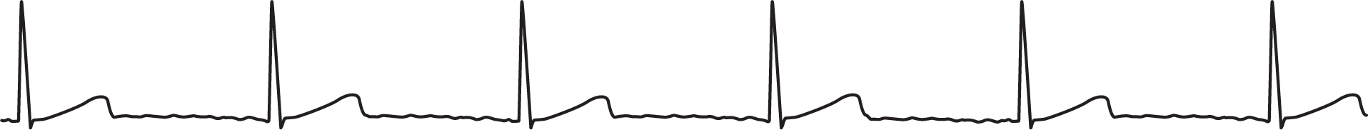 A rhythm strip shows junctional rhythm with fluctuating baseline.