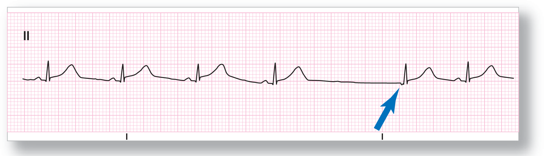 A rhythm strip from lead 2 illustrates sinus rhythm with a junctional escape complex.