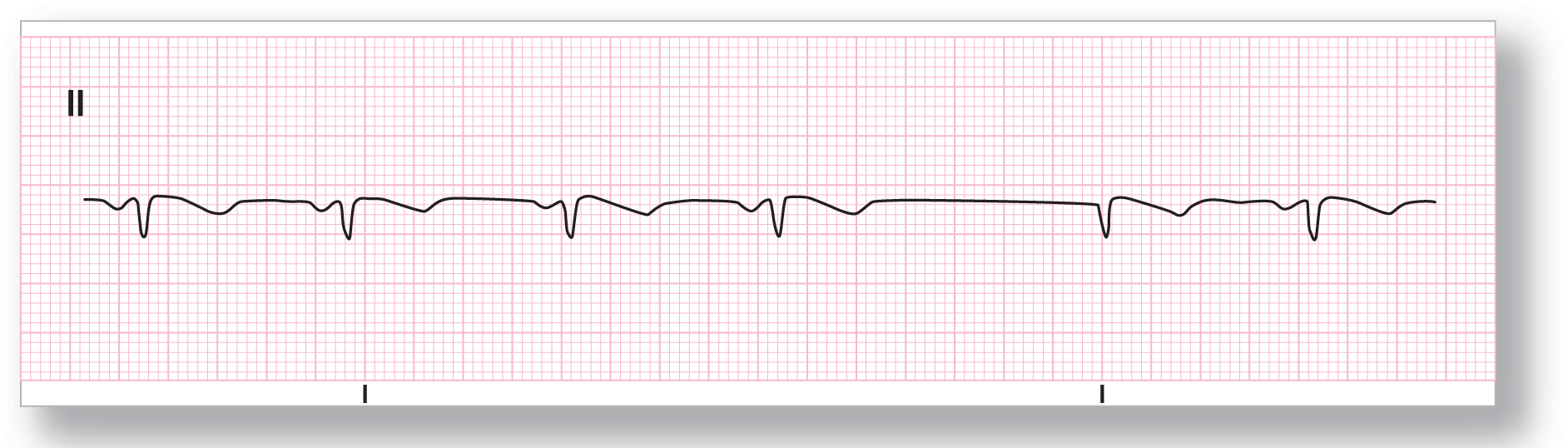 A rhythm strip from lead 2 shows a short dip of the P wave, a sharper dip of the QRS complex, and a wide dip of the T wave. A junctional escape complex occurs after a long pause with a missing P wave.