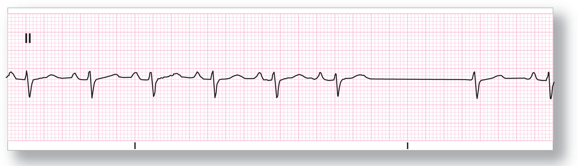 A rhythm strip from lead 2 shows a curved peak of the P wave, a sharp peak of the R wave, a sharp dip of the S wave, and a wide peak of the T wave. A junctional escape complex occurs after a long pause with a missing P wave.