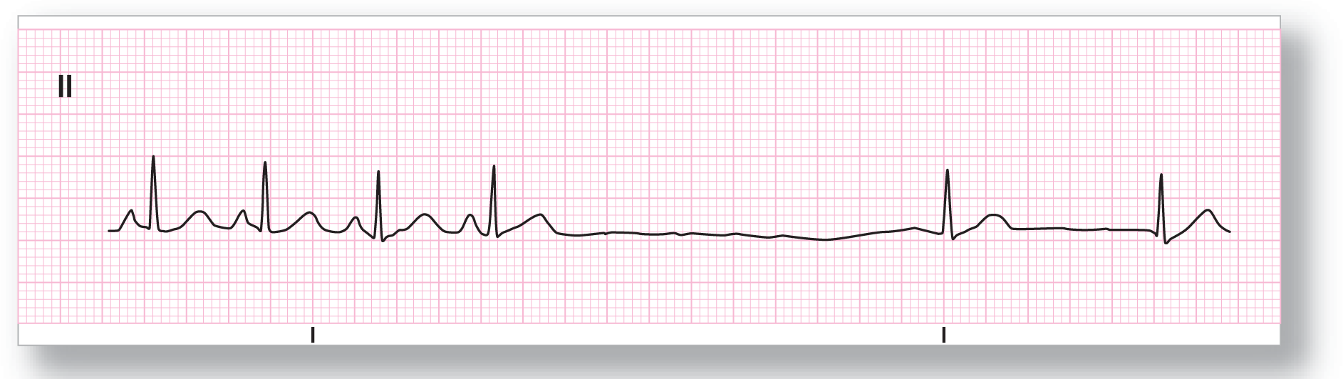 A rhythm strip from lead 2 shows curved peak of the P wave, a sharp peak of the QRS complex, and a wide peak of the T wave. A complex without P wave occurs after a long pause, followed by another complex without P wave after a shorter pause.