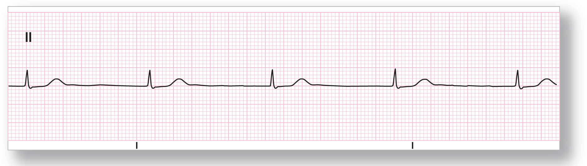 A rhythm strip from lead 2 shows a sharp peak of the QRS complex, a subtle dip, and a wide and curved peak of the T wave. P waves are missing.