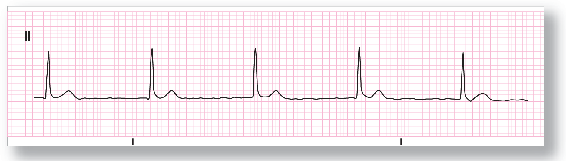 A rhythm strip from lead 2 shows a sharp peak of the QRS complex and a wide and curved peak of the T wave, with mildly fluctuating baseline.