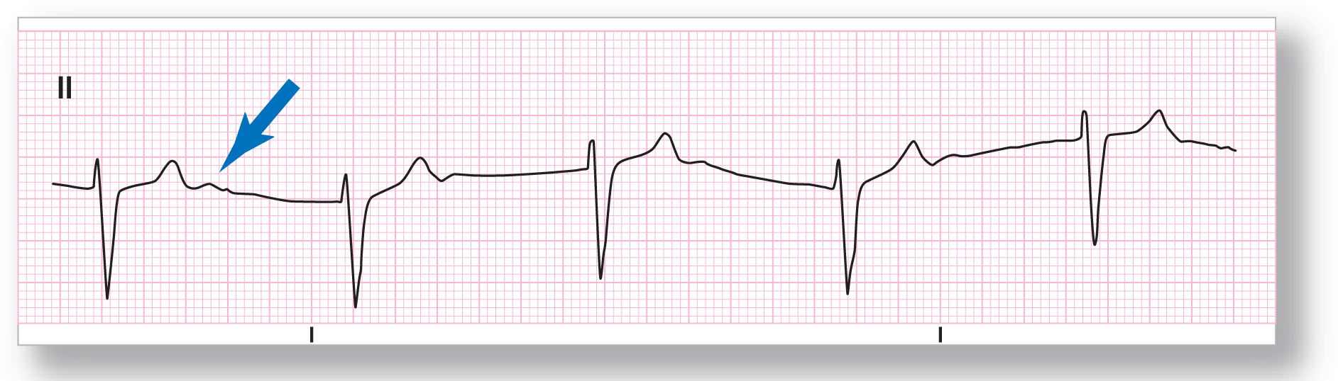 A rhythm strip from lead 2 shows a sharp dip of the QRS complex and a curved peak of the T wave. An arrow points toward a small peak in the first complex. The baseline of the strip wanders.