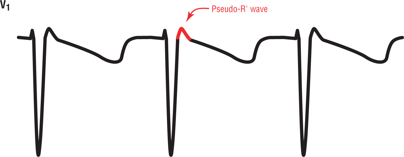 A rhythm strip from lead V1 shows a sharp dip of the QRS complex, a small and subtle peak of the pseudo R prime wave, and a wide and curved dip of the T wave. P wave is missing.