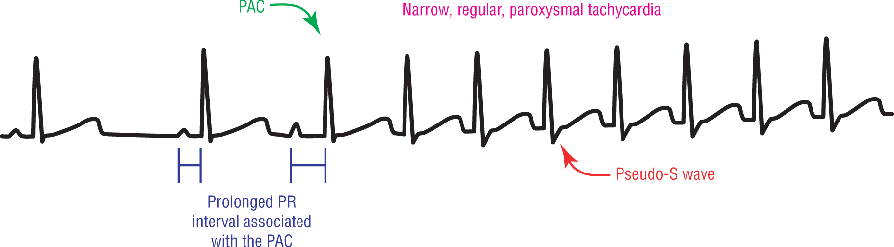 An ECG complex illustrates findings in AV nodal reentry tachycardia.