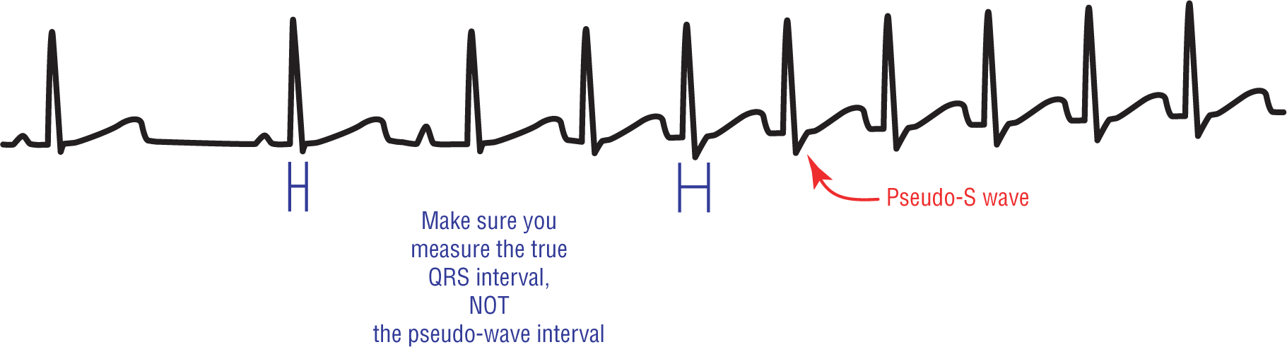 An ECG complex illustrates the calculation of QRS interval in AVNRT.