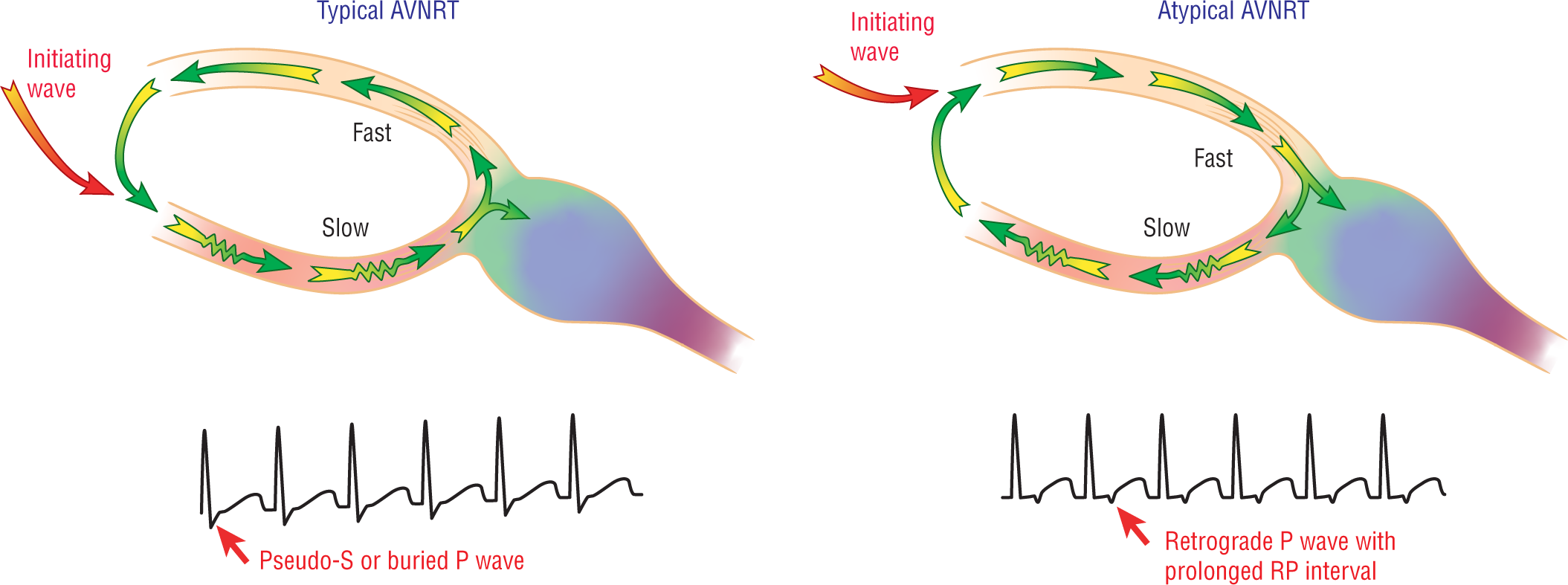 An illustration shows typical and atypical AVNRT.