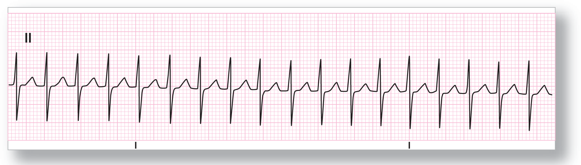 A rhythm strip from lead 2 shows a sharp and narrow peak of the R wave, sharp and narrow dip of the S wave, and a wide and curved peak of the T wave. The baseline falls.