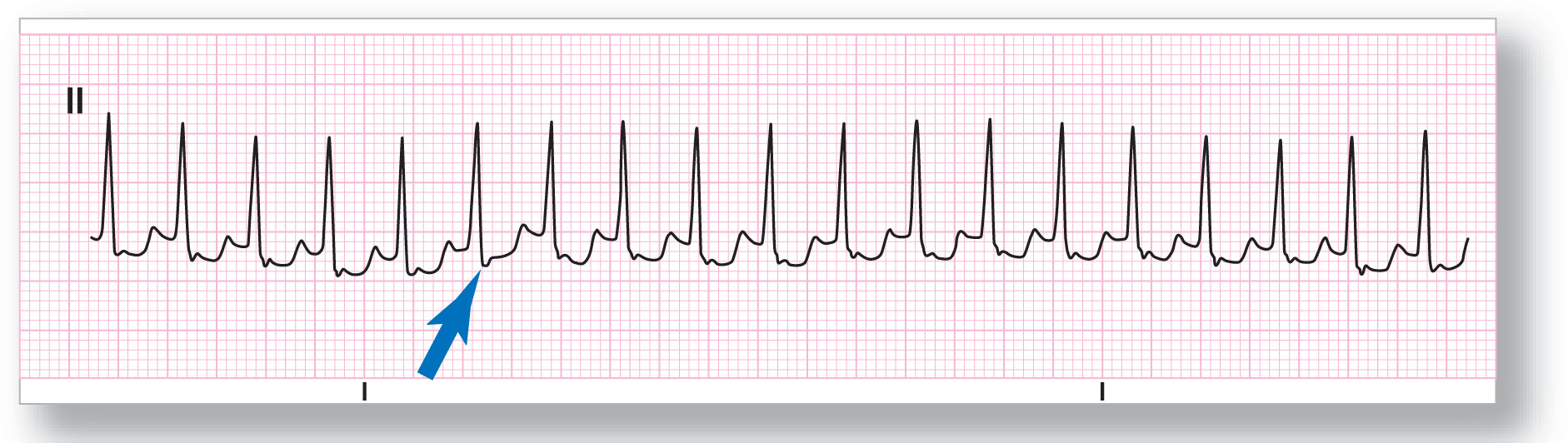 A rhythm strip from lead 2 shows a sharp peak of the QRS complex, an indiscernible peak of the P wave as pseudo-S wave in the ST segment, and a small and curved peak of the T wave.