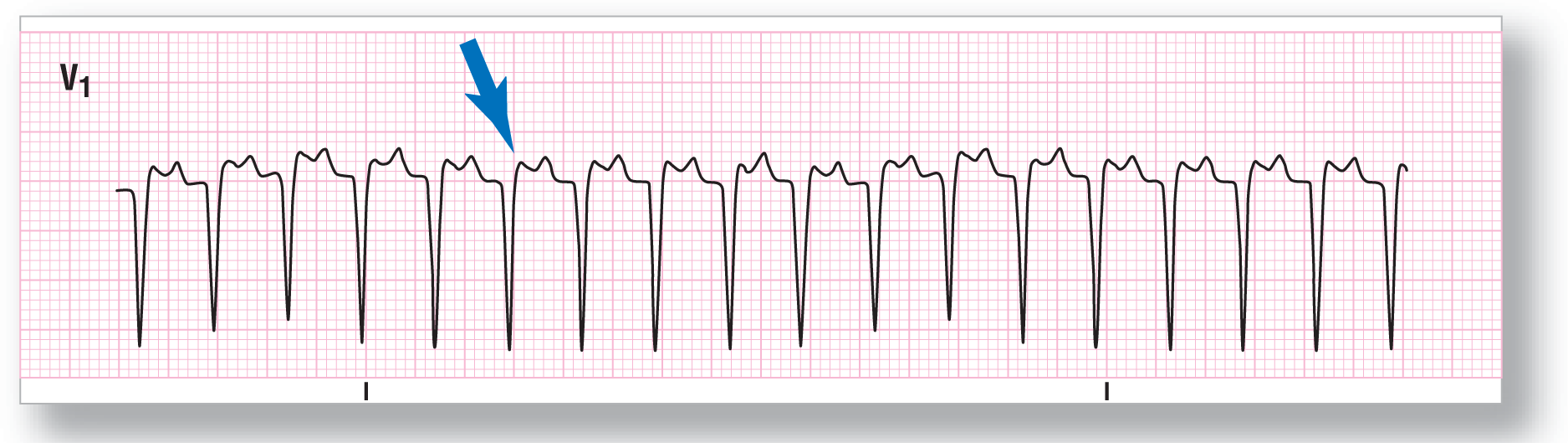 A rhythm strip from lead V1 shows a sharp dip of the QRS complex, an indiscernible peak of the P wave as pseudo-R prime wave, and a small peak of the T wave.