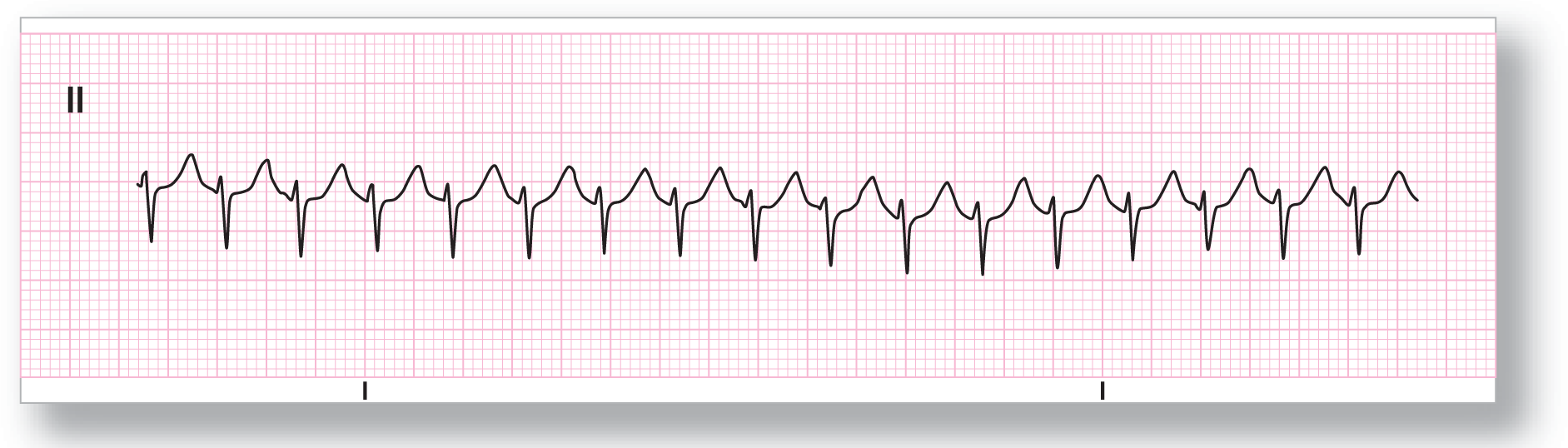 A rhythm strip from lead 2 shows a sharp and narrow dip of the QRS complex and a wide and curved peak of the T wave.