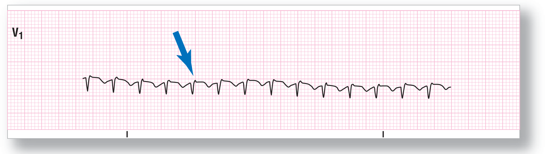 A rhythm strip from lead V1 shows a small and sharp dip of the QRS complex, an indiscernible peak of the P wave as pseudo-R prime wave, and a small and curved dip of the T wave.