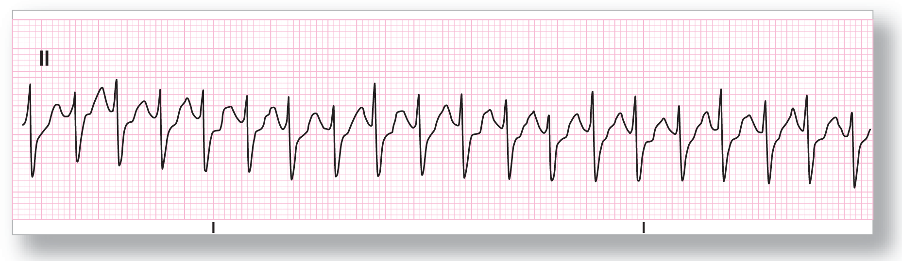 A rhythm strip from lead 2 shows a sharp and narrow peak of the R wave, a sharp dip of the S wave, and a wide and curved peak of the T wave.