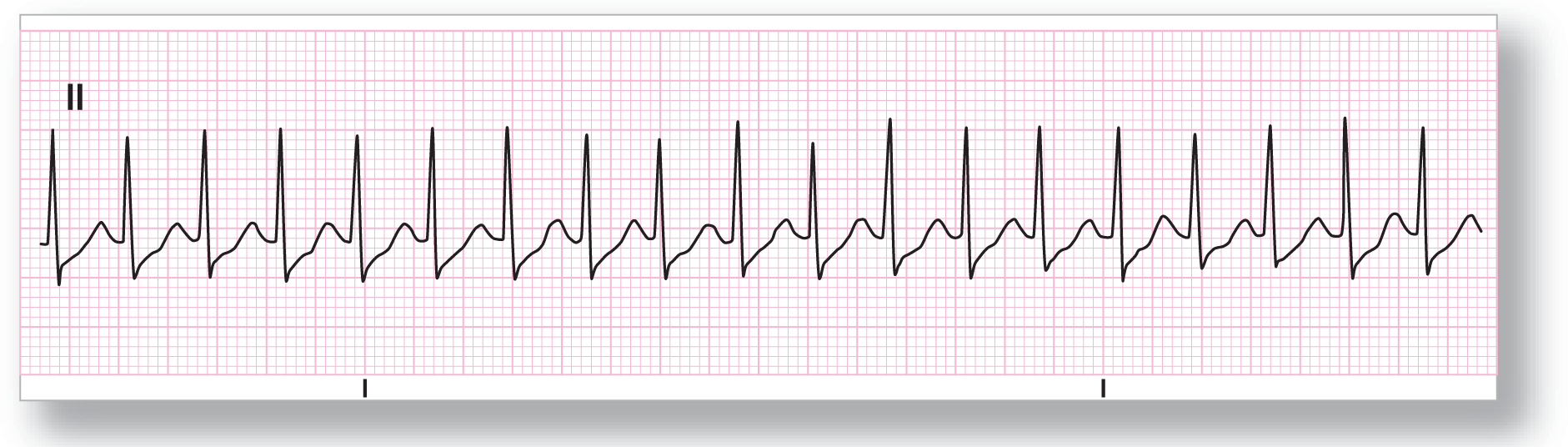 A rhythm strip from lead 2 shows a sharp, tall, and narrow peak of the QRS complex, an indiscernible depression in the ST segment, and a small and curved peak of the T wave.