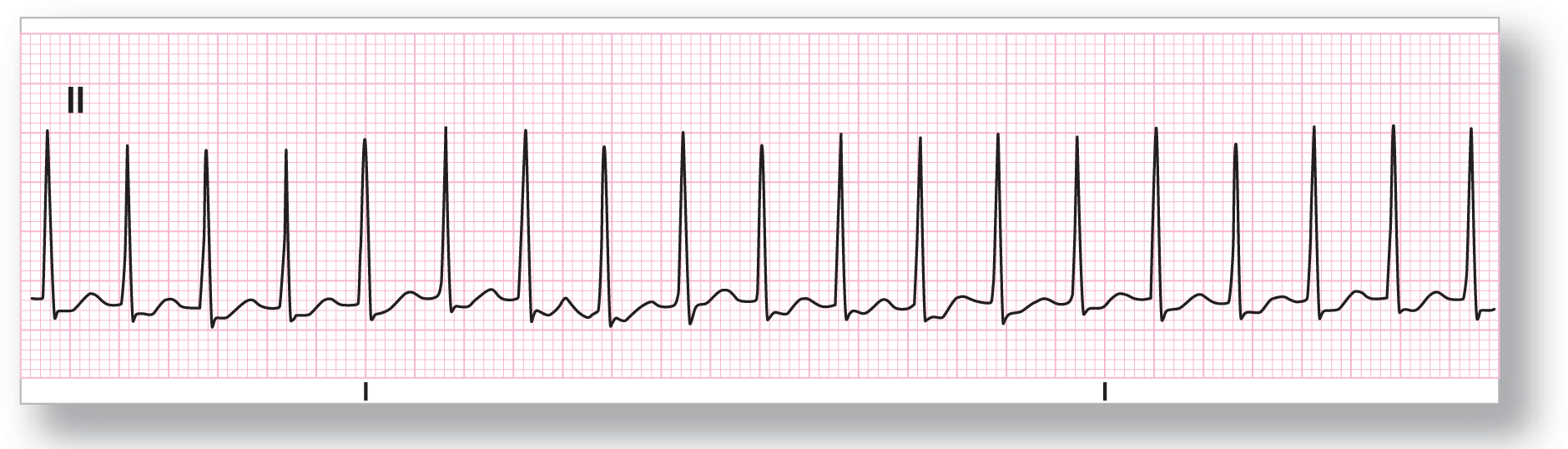 A rhythm strip from lead 2 shows a tall, narrow, and sharp peak of the QRS complex, a small dip in the ST segment, and a small, wide, and curved peak of the T wave.