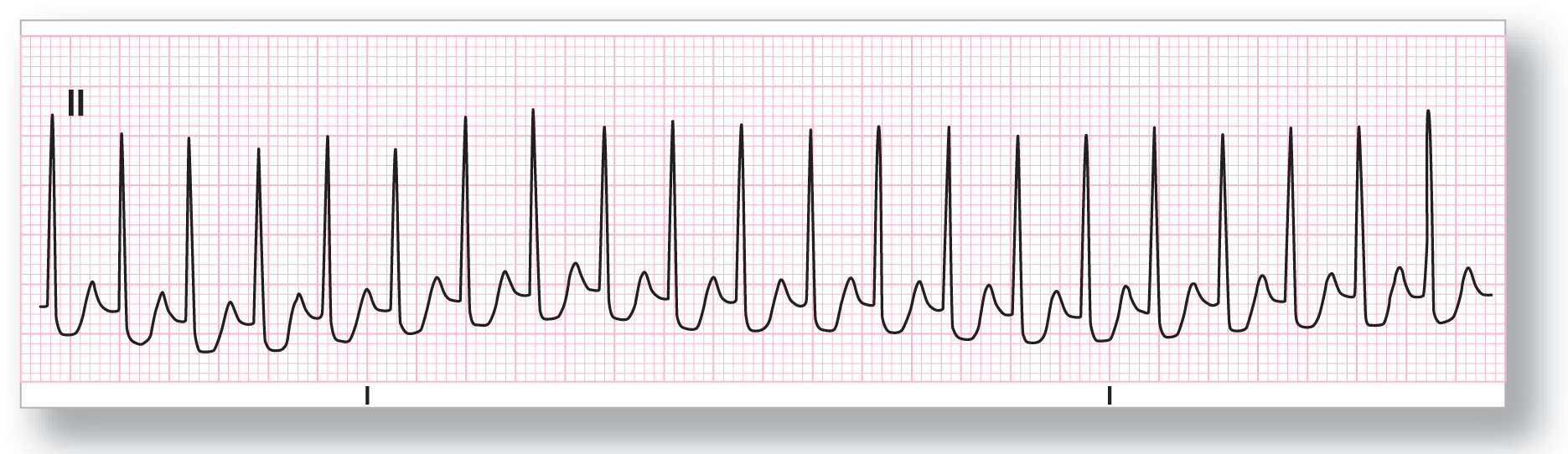 A rhythm strip from lead 2 shows tall, narrow, and sharp peaks of the QRS complex, ST segment with scooped-out appearance, and a small and curved peak of the T wave.