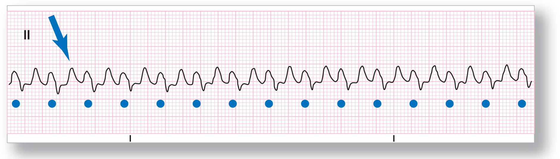 A rhythm strip from lead 2 shows a curved peak and a small dip of the QRS complex and a taller and curved peak of the T wave.