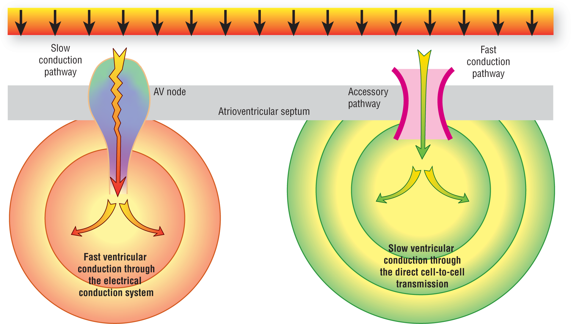 An illustration shows the passage of an impulse through AV node and accessory pathway located in the atrioventricular septum.