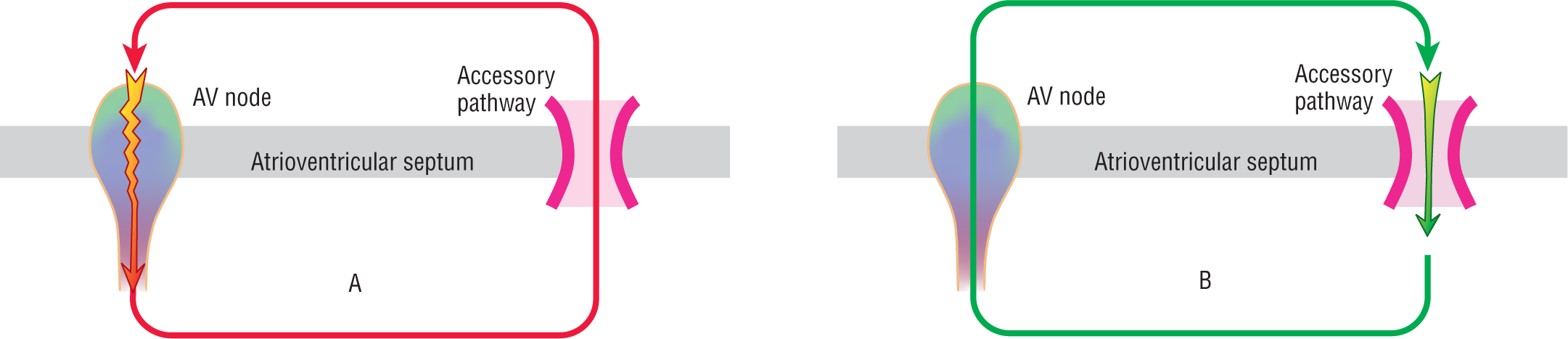 Two illustrations, A and B, show the possible reentry circuits formed in AVRT.