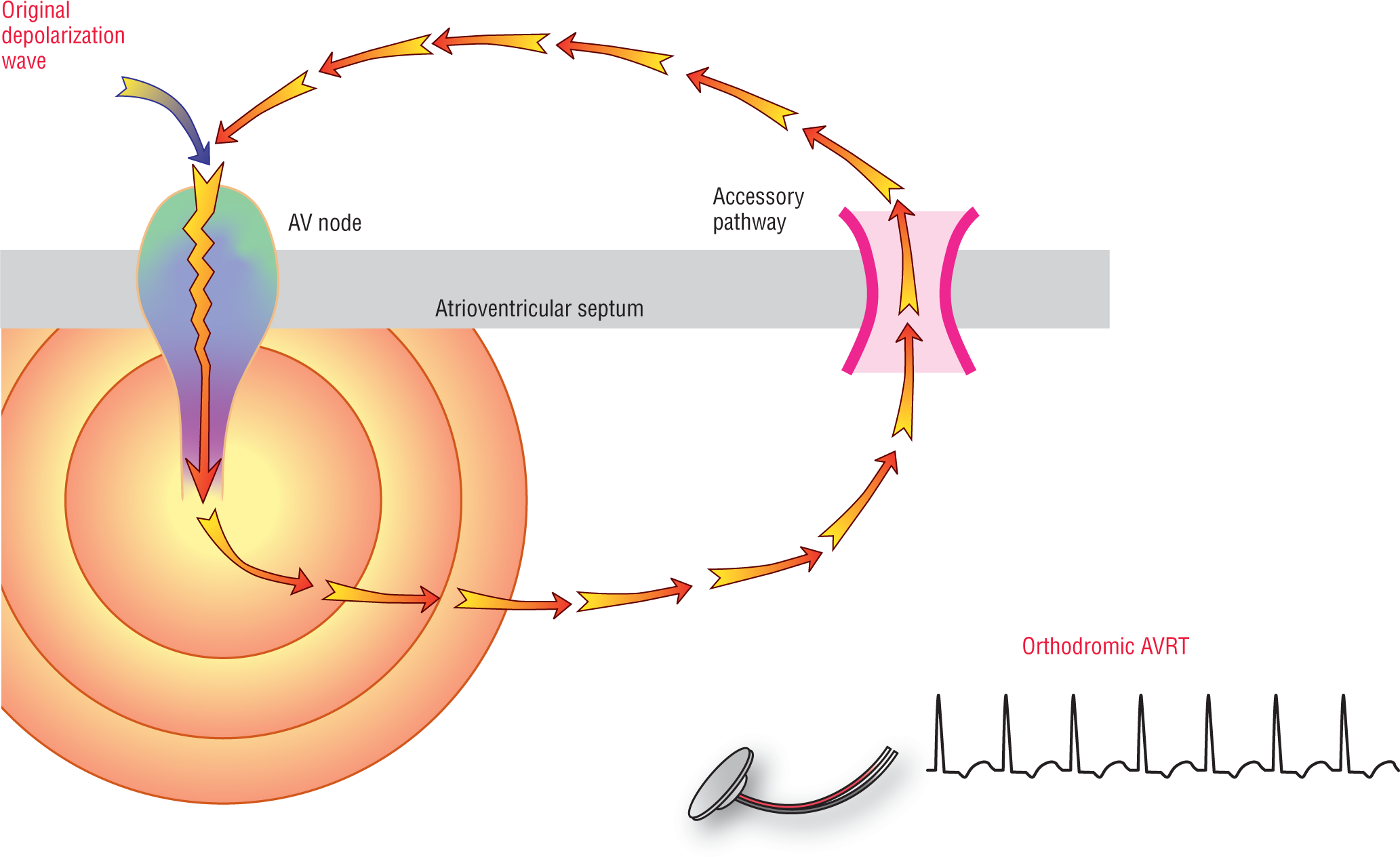 An illustration shows orthodromic AVRT and its ECG waveform.