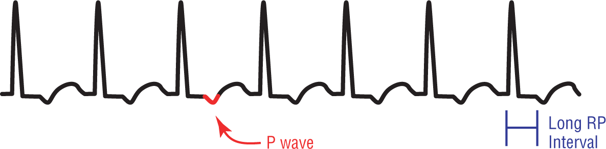 An ECG complex shows a short, wide, and curved peak, a tall, narrow, and sharp peak of the QRS complex, and an inverted peak of the P wave. RP intervals are long.