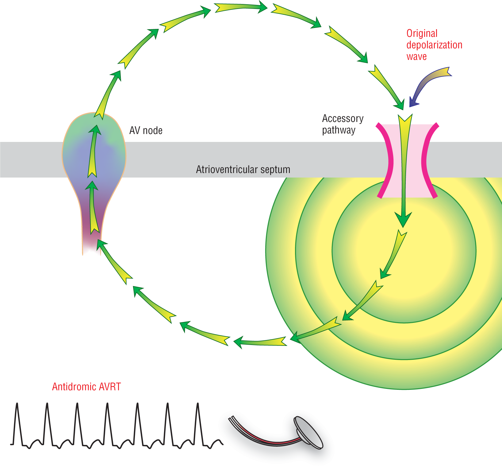 An illustration shows antidromic AVRT and its ECG waveform.