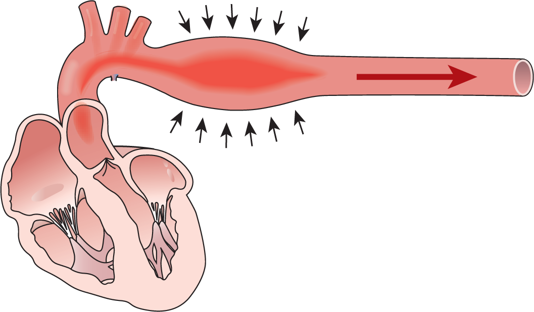 An illustration shows a bolus of blood moving through the aorta, causing it to be distended.