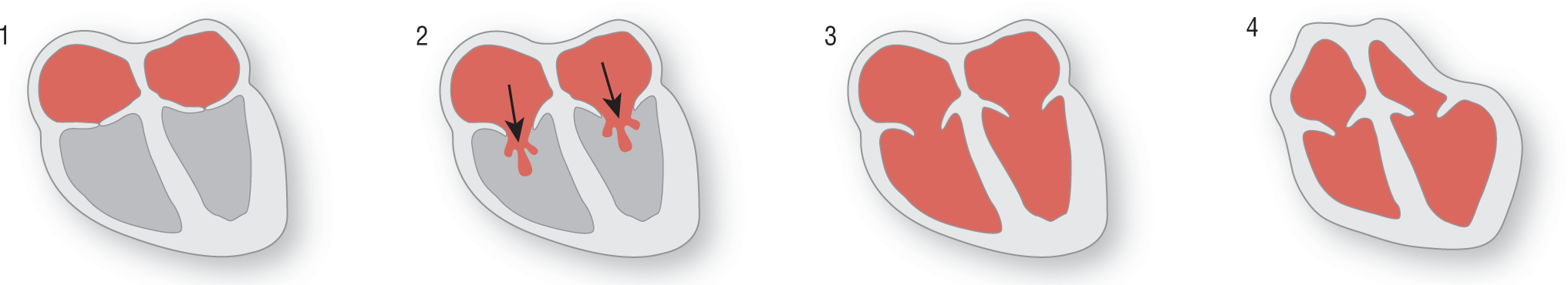 An illustration shows four stages in normal ventricular filling.