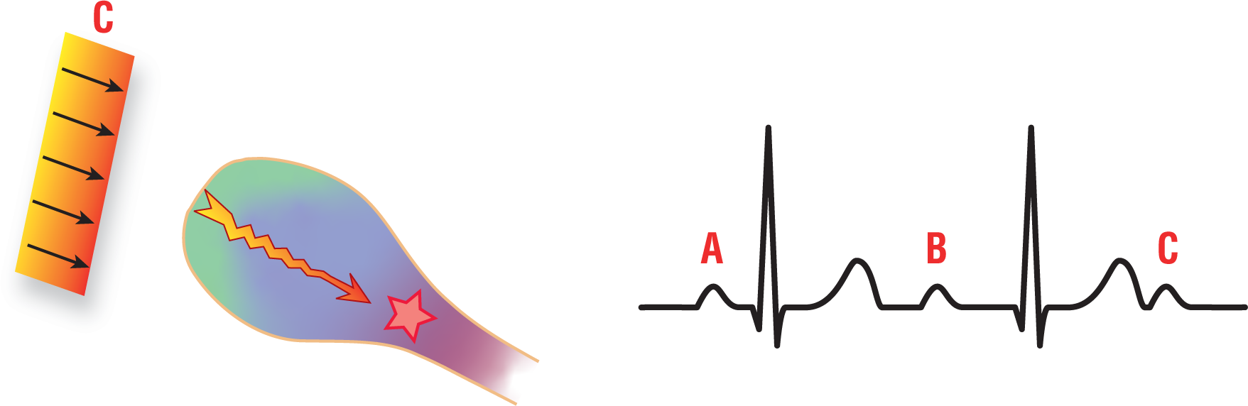 An illustration shows sinus wave C approaching the AV node. It barely passes through it, resulting in two normal ECG complexes, A and B, and a P wave of the third complex, C.