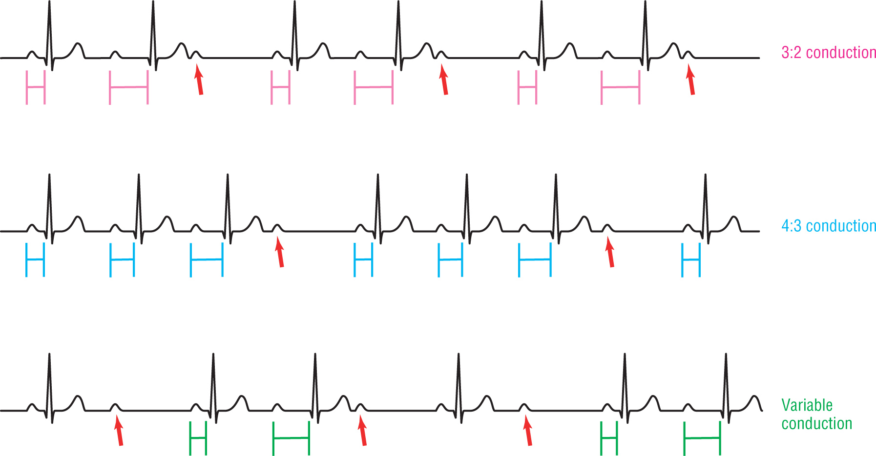 ECG complexes show that in 3 to 2, 4 to 3, and variable conductions, the PR interval keeps prolonging till the dropped beat.