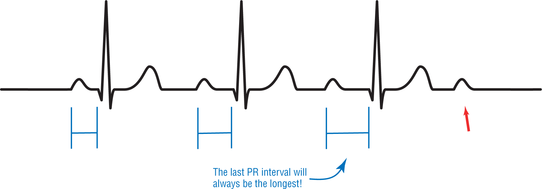 An ECG complex shows that the last PR interval immediately before the dropped beat is the longest.