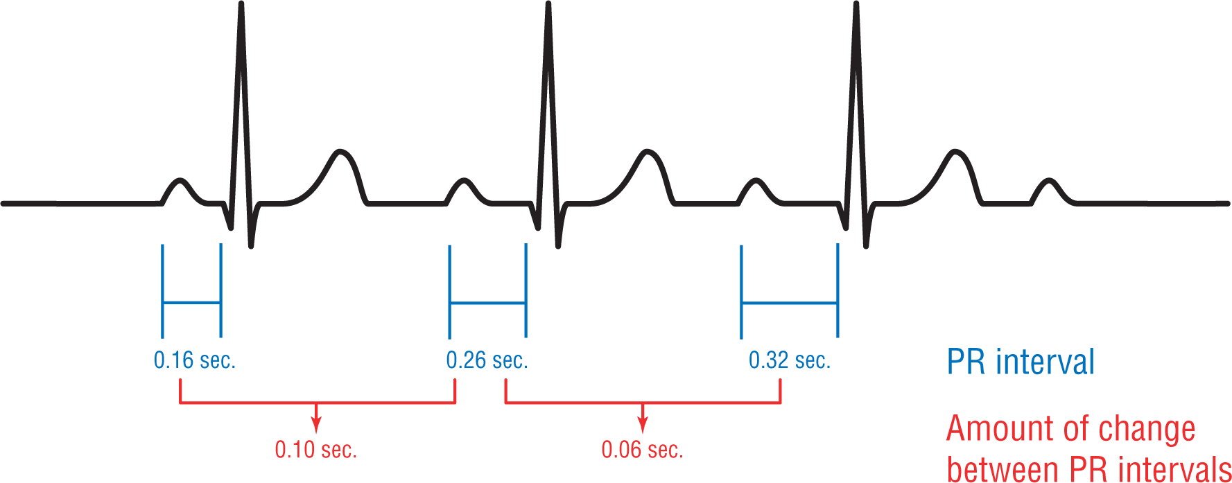 In an ECG complex, the consecutive PR intervals in seconds are 0.16, 0.26, and 0.32. The amount of change between two consecutive intervals in seconds is 0.10 and 0.16.