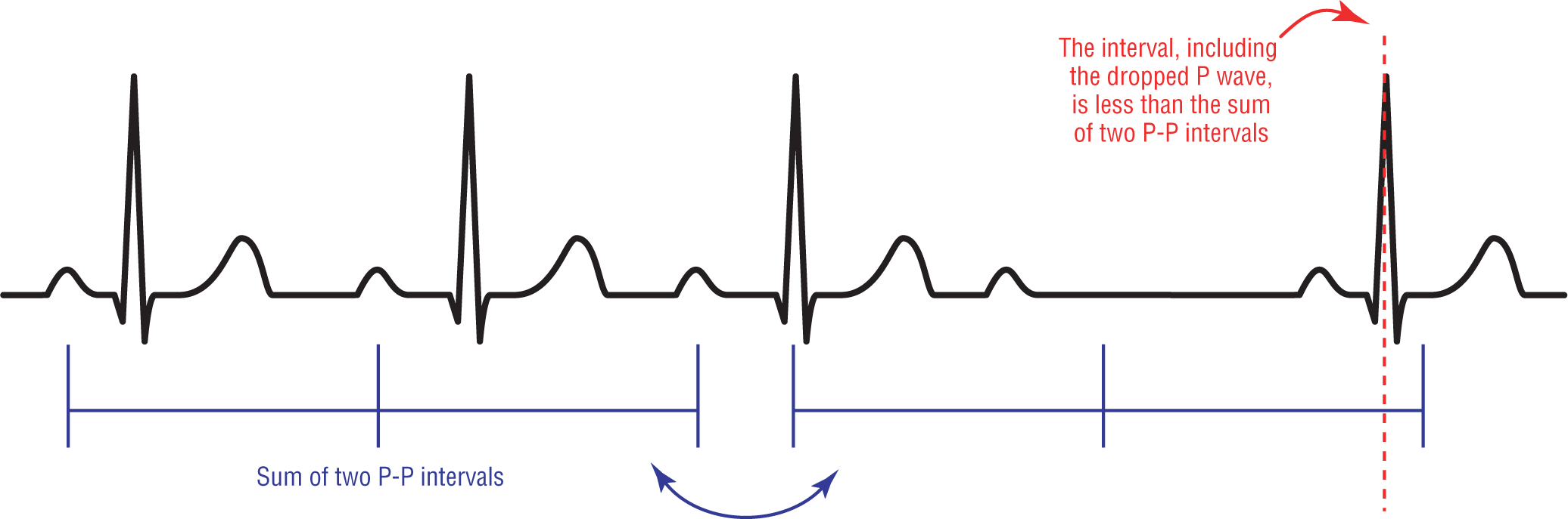 An ECG complex with a dropped P wave shows that an interval, including the dropped P wave, is less than the sum of two P-P intervals.